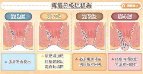 為什麼會長痔|痔瘡怎麼產生？有什麼症狀？如何預防治療？醫師完整圖文解說｜ 